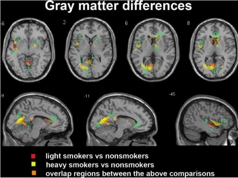 धूम्रपान करने से मस्तिष्क सिकुड़ जाता है- अध्यन