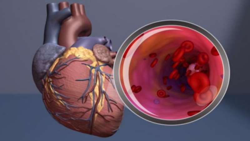 बंद धमनियों में मौजूद माइक्रोप्लास्टिक से दिल का दौरा पड़ने का खतरा बढ़ सकता है: अध्ययन