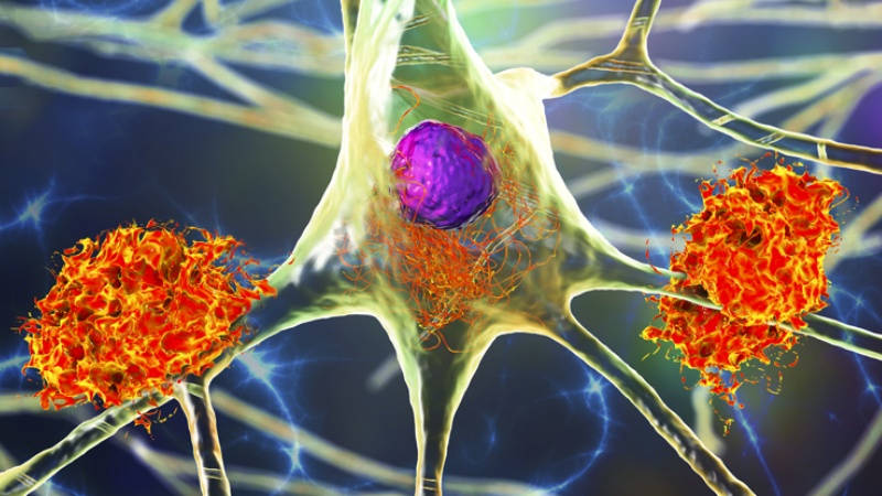 वैज्ञानिकों ने अल्जाइमर रोग के खतरे को कम करने वाला आनुवंशिक उत्परिवर्तन खोज लिया