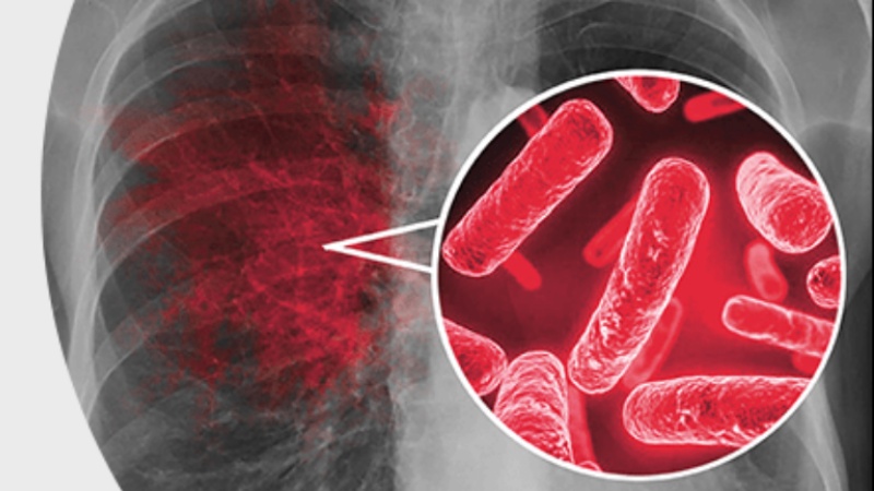 टीबी ग्रस्त महिलाओं को शादी के लायक नहीं समझते ये तलाक़ दे देते हैं- अध्ययन