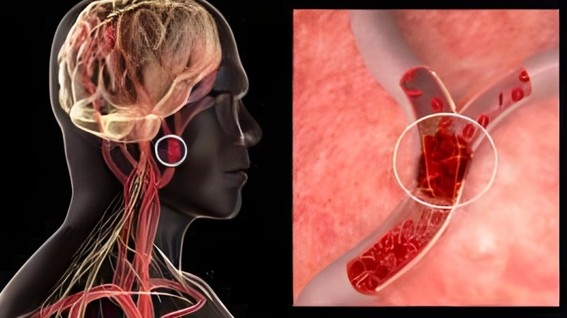 युवाओं में स्ट्रोक के मामले बढ़ रहे हैं- वर्ल्ड हेल्थ ऑर्गनाइज़ेशन 