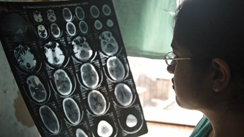न्यूरोलॉजिकल समस्याओं से सालाना एक करोड़ से ज़्यादा मौतें